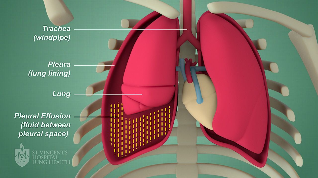 Pleural effusion